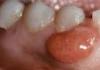 Доброкачественные опухоли полости рта Почему во рту появилась шишка во рту