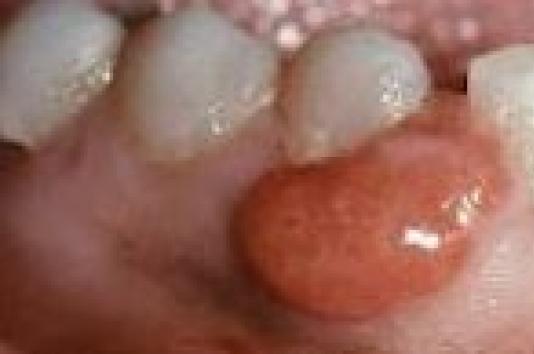 Доброкачественные опухоли полости рта Почему во рту появилась шишка во рту